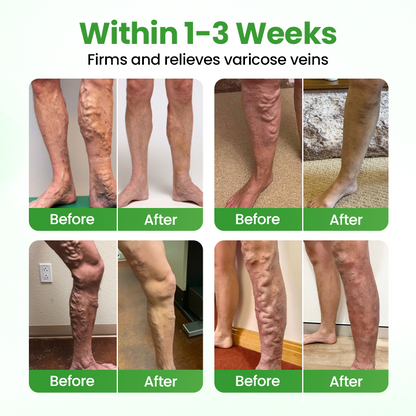 Healrize® VeinHeal Microneedle Patch