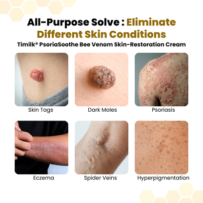 Timilk® PsoriaSoothe Bee Venom Skin-Restoration Cream.