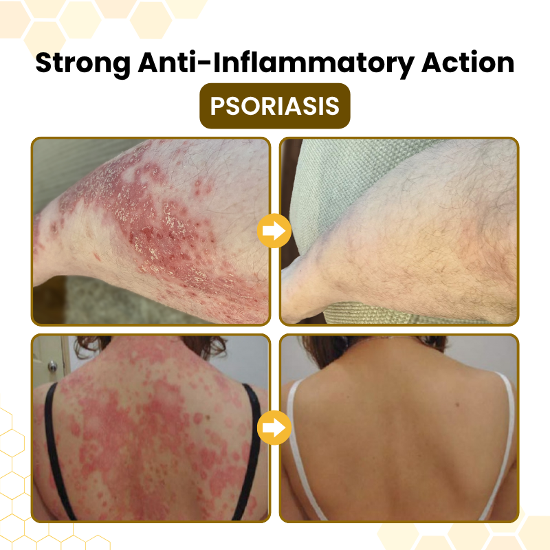 Timilk® PsoriaSoothe Bee Venom Skin-Restoration Cream.