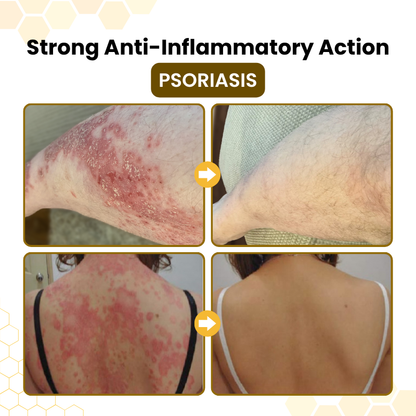 Timilk® PsoriaSoothe Bee Venom Skin-Restoration Cream.